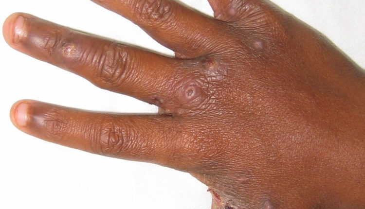 Scabies Rash On African American Skin 